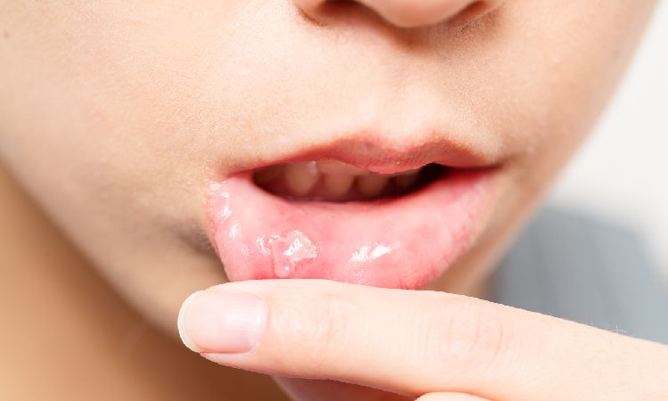 Afty – poznaj przyczyny ich występowania i sposoby leczenia - Apteka internetowa Melissa