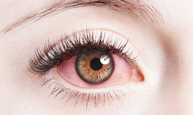  Alergiczne choroby oczu – jak je rozpoznać?  