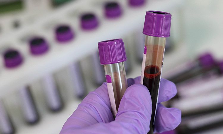  Diagnostyka anemii -  kompleksowe badania krwi 