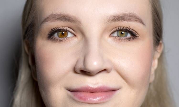 Heterochromia