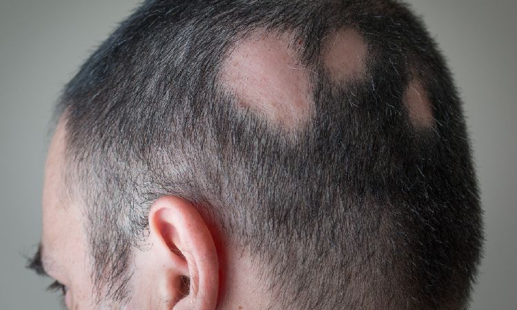  Jak rozpoznać łysienie plackowate? 