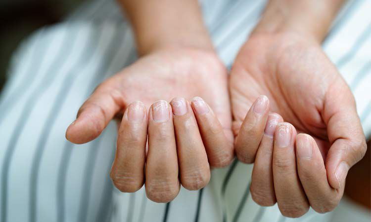  Osłabione paznokcie po hybrydzie z miękką i uszkodzoną płytką 