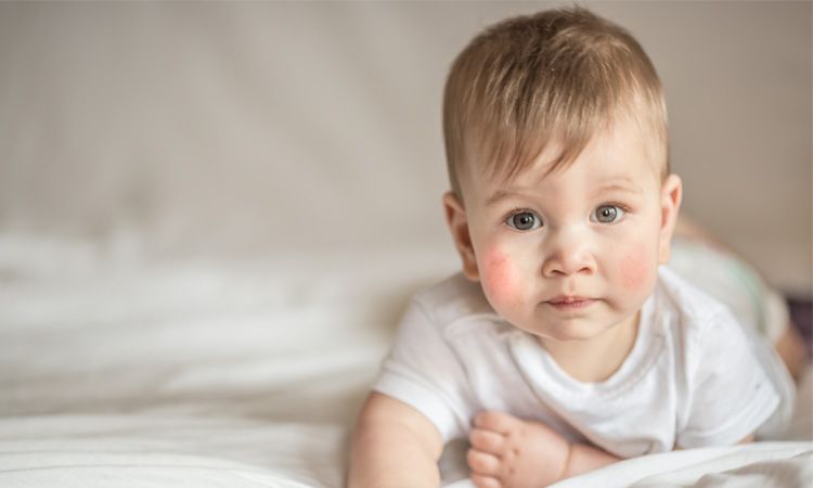  Skóra atopowa u niemowląt i dzieci – jak ją właściwie pielęgnować? 