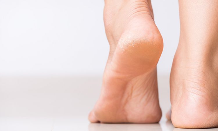 Zespół stopy cukrzycowej – jakie są jego objawy i jak wygląda leczenie?