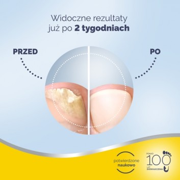 Scholl, preparat na grzybicę paznokci, 3,8 ml - obrazek 5